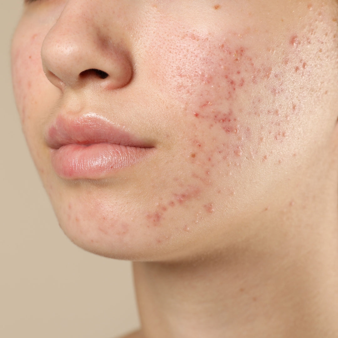 Rood en nabij-infrarood licht gebruiken tegen puistjes en acné - hoe werkt het en wat zijn de voordelen?